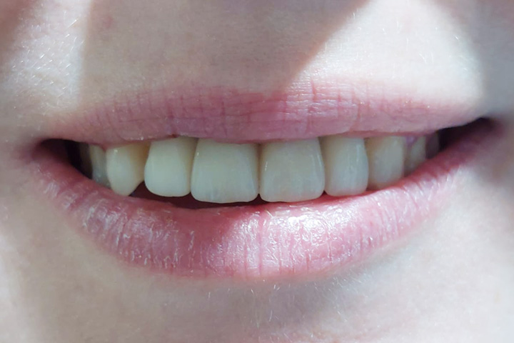 Lächelnde Frau mit Implantaten und Zahnkronen nach Unfall